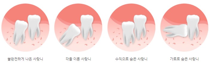 wisdomtooth_03.jpg